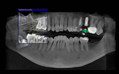 Radiología 3D: La tecnología al servicio de la planificación