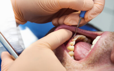 ¿Cuál es la diferencia entre gingivitis y periodontitis?
