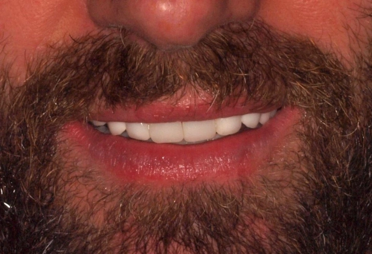 laminados-ceramicos-6-despues